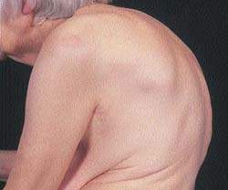Výrazná kyfóza uprostřed osteoporózy