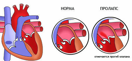 Mitral valve prolapse of 1,2 and 3 degree: treatment and prognosis |Med. Consultant - Health On-Line