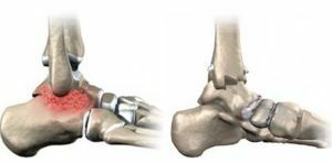 Artrodes - funkčná imobilizácia kĺbov