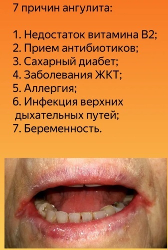 Pengobatan retak di sudut mulut, selai, jika tidak sembuh. Angulitis pada anak-anak, orang dewasa