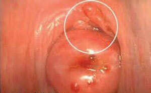Quiste cervical: ¿qué es? Síntomas y tratamiento de quistes, foto