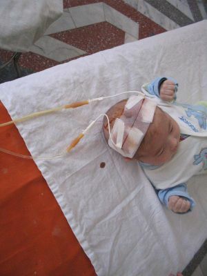 Zapalenie Ventriculitis - okołostawowe ropne zapalenie mózgu u noworodków
