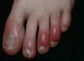 În fotografie, artrita acută a articulațiilor degetelor de la picioare