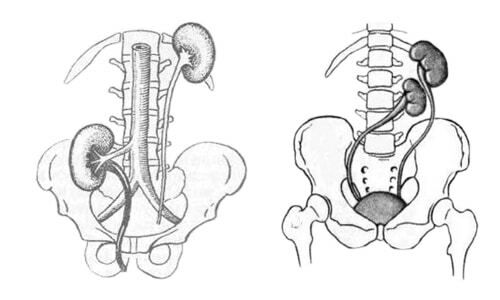 congenital kidney anomaly