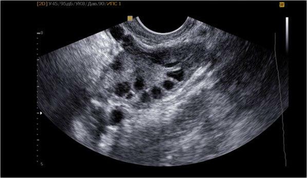 Ultrasound of the small pelvis with a cyst