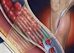 Treatment of deep vein thrombosis of lower extremities