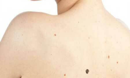 Photo initiale du cancer de la peau