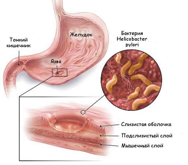 Razjeda v želodcu in njeni vzroki