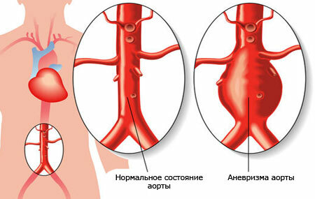 Što je aorte aneurizma?
