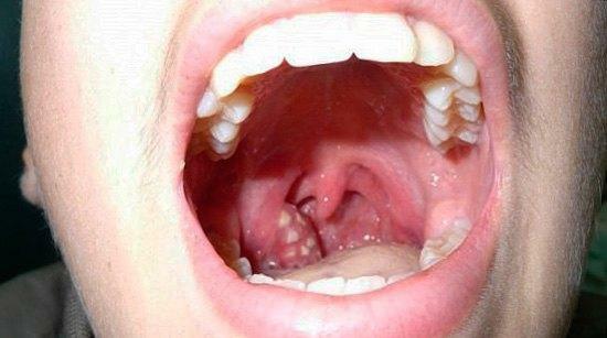 Gola con mal di gola follicolare