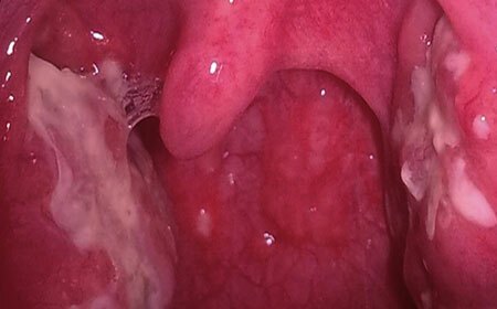 Purulent angina hos et barn og en voksen: behandling, fotos af symptomer