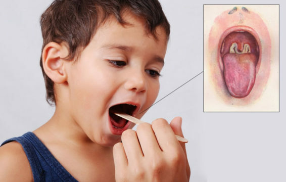 Plaque on the tonsils