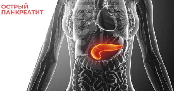 Acute pancreatitis in a woman. Symptoms and treatment, drugs