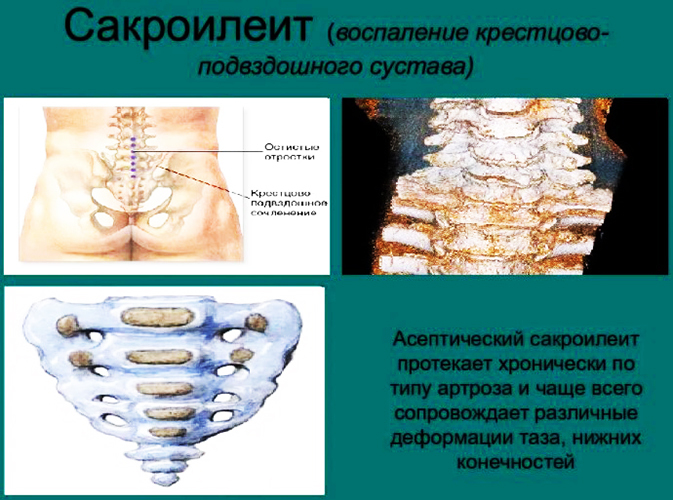 Sacroiliitis of the sacroiliac joint, joint