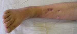 Treatment of osteomyelitis. Prophylaxis and possible complications