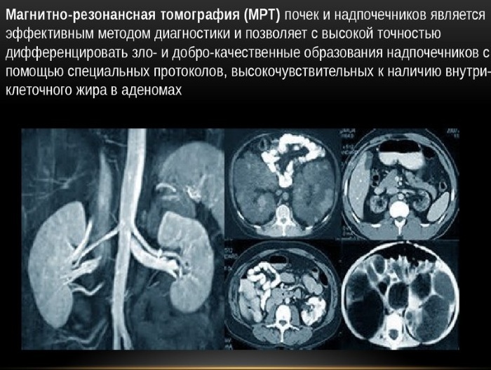 MRI of the kidneys and urinary tract. Price, which shows how it is done, preparation