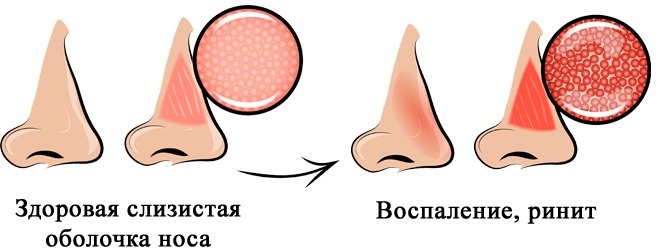 Hormonske kapi za nos za rinitis, začepljenje, alergije, steroid za djecu. Popis, naslovi, cijene