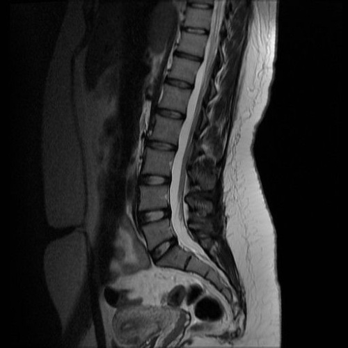 espina dorsal de la cola de caballo. Anatomía, foto, síntomas y tratamiento para hombres, mujeres