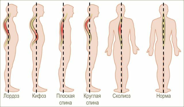 סוגי העקמומיות של עמוד השדרה