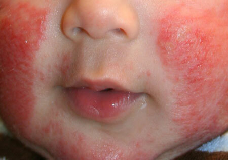 Atopic dermatitis in children, photo