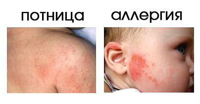 Prakaitavimosi ir alergijos skirtumai