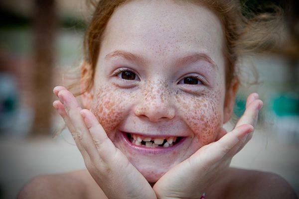 Freckles em crianças geralmente não excluem nada