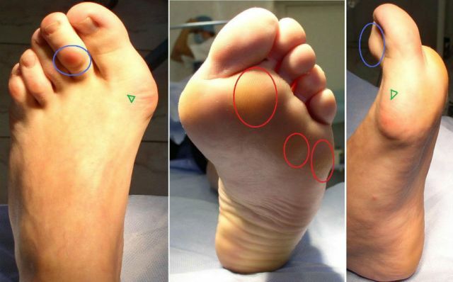 vervorming van osteoartritis van de voet