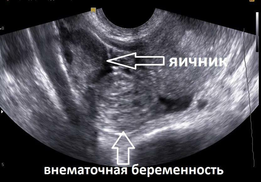 Ectopic pregnancy in the picture