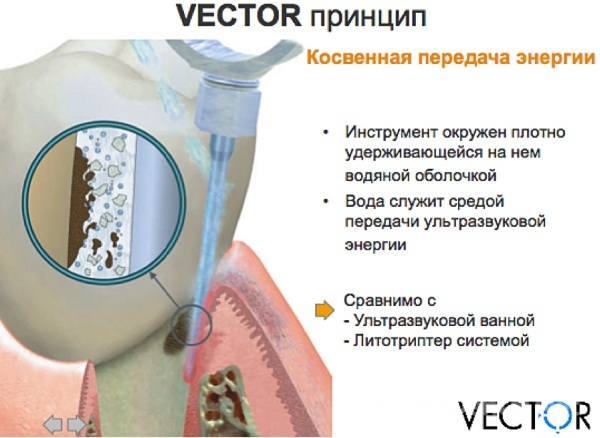Vector device for the treatment of periodontitis, gums, teeth cleaning in dentistry. What it is