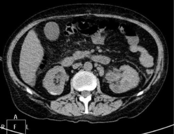 CT of the kidneys with contrast. What is it, what shows, preparation, contraindications, price