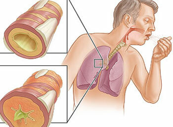 Symptomer på bronchial astma