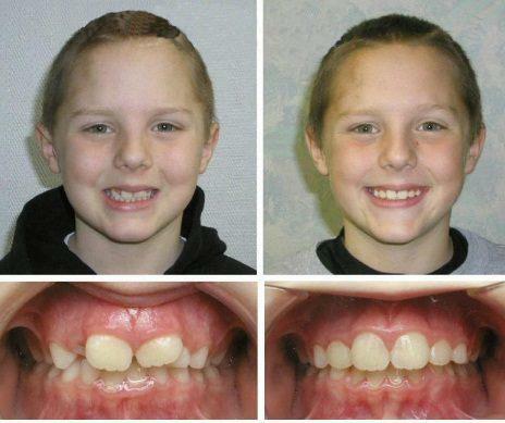 Before and after treatment of prognathic occlusion in children