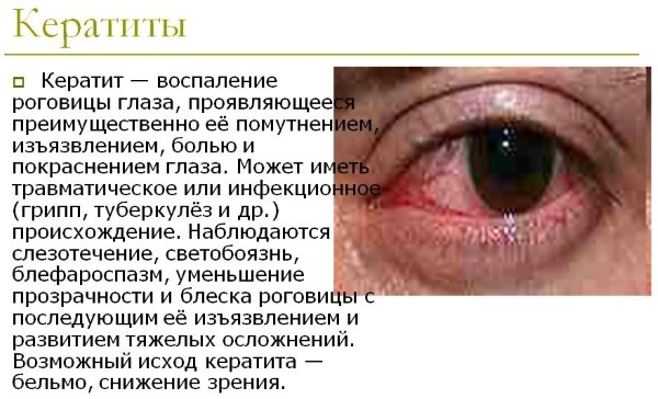 Opatanol (Opatanol) eye drops. Price, instructions for use, analogues, reviews