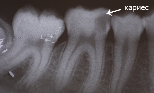 So entfernen Sie schwarze Streifen auf den Zähnen eines Kindes