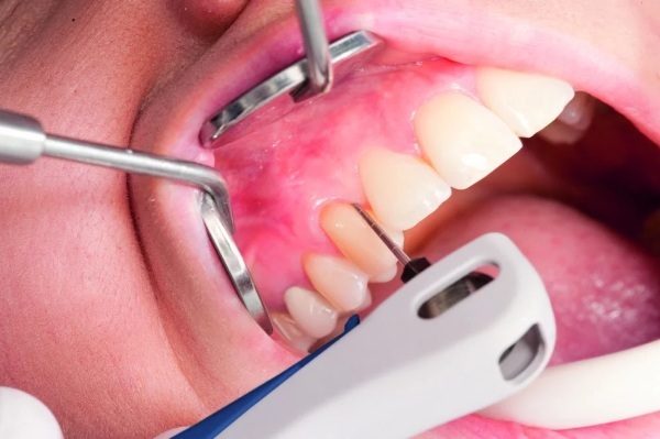 Vector device for the treatment of periodontitis, gums, teeth cleaning in dentistry. What it is