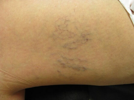 Asteriscos vasculares nas pernas: tratamento, avaliações, fotos