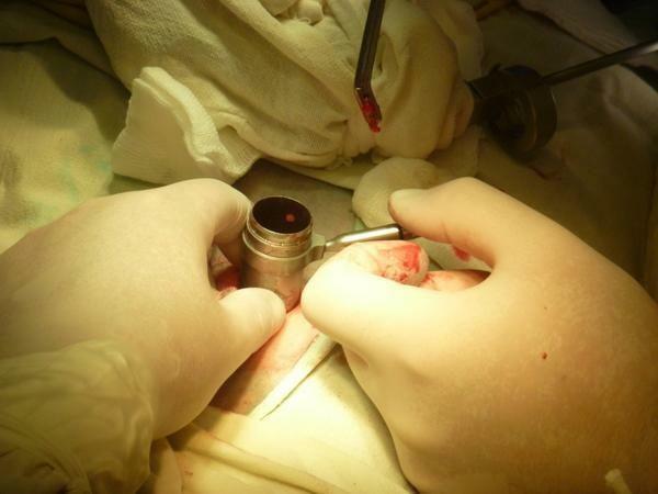 Forberedelse for lumbal ryggraden kirurgi