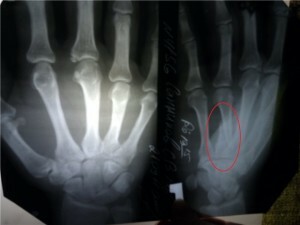 Zdjęcie rentgenowskie poszkodowanej dłoni