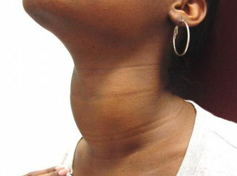 Goiter of the thyroid gland