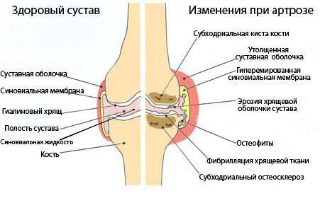 A healthy joint and changes in arthrosis