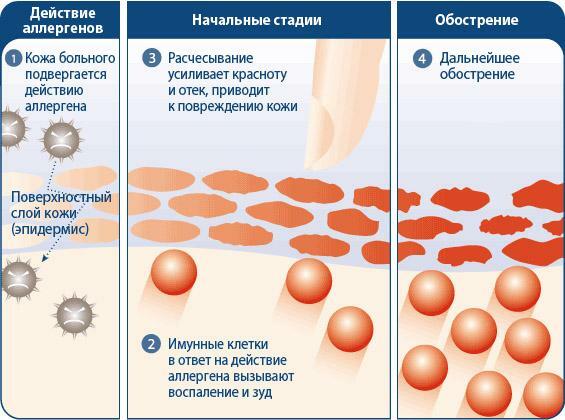 Entwicklung von allergischer Dermatitis