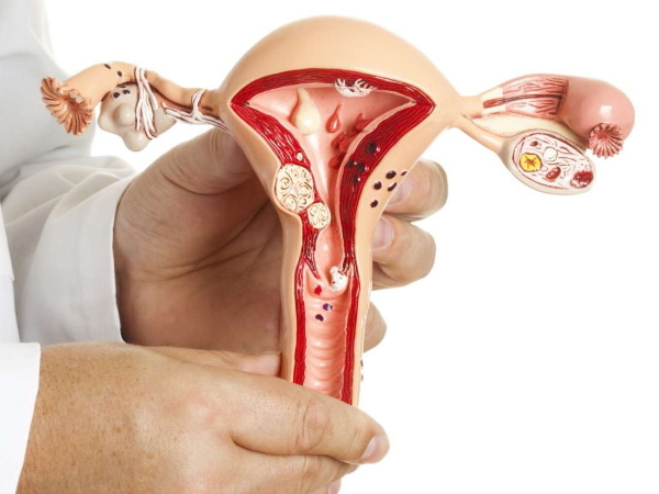 Laser avlägsnande av en polyp i livmodern, endometrial hysteroskopi. Beredning, återhämtningsperiod
