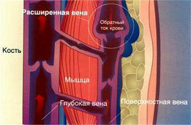 Symptoms of varicose veins