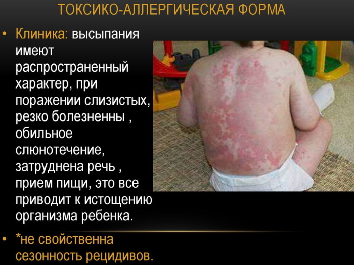 Erythema multiforme exudative. Differential diagnosis, treatment
