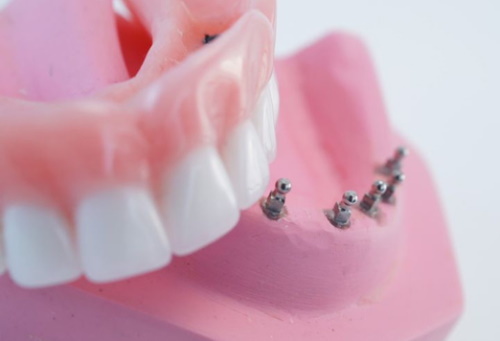 Prótese dentária condicionalmente removível em implantes para o maxilar superior e inferior. Preço