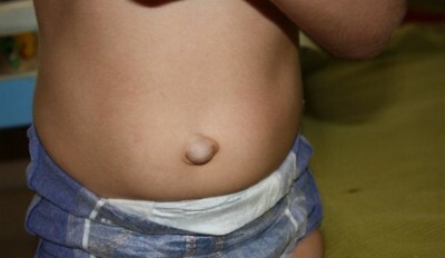 Umbilikalna kila kod odraslih( žena, muškaraca): simptomi, liječenje, nego opasni