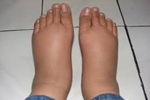 foot swelling