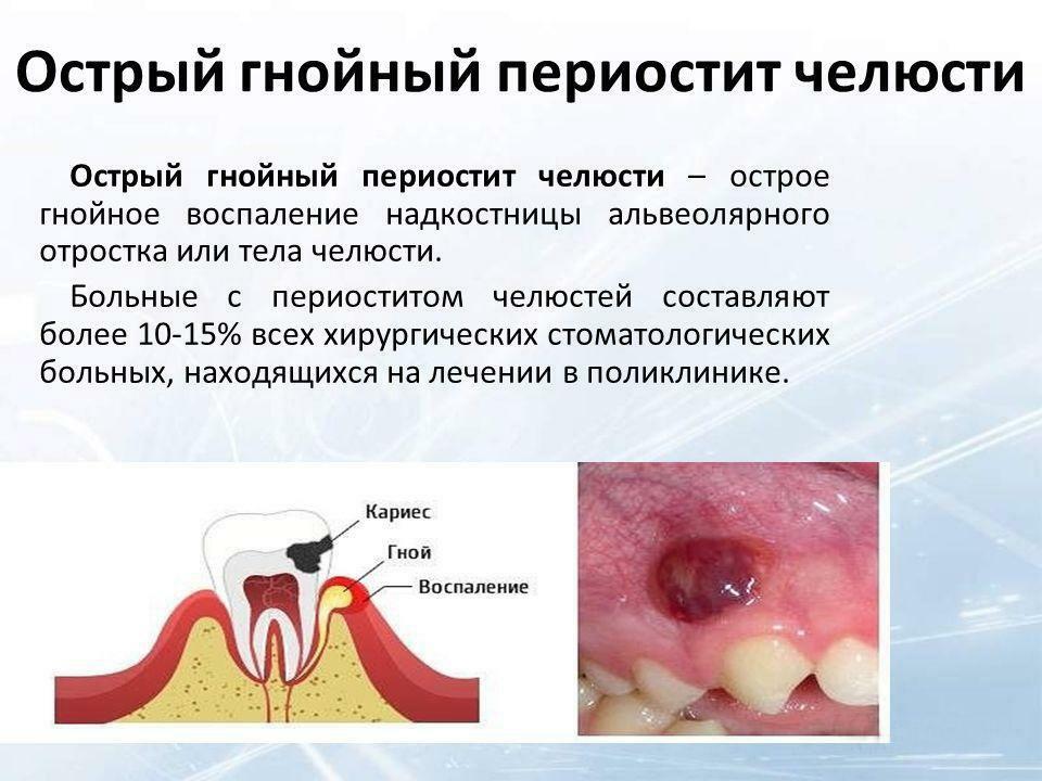 Definition of acute purulent periostitis of the jaw