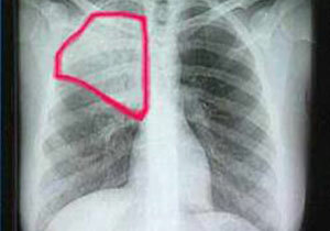 Diagnosis of pneumonia