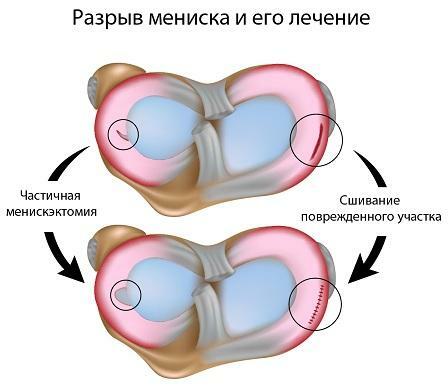 Ruptura și tratamentul meniscului